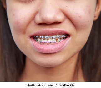 Teen Asian Ethnicity Problems With Teeth Can Be Treated With Braces To Treat Symptoms Prognathism Make Mouth Awry.