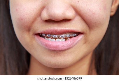 Teen Asian Ethnicity Problems With Teeth Can Be Treated With Braces To Treat Symptoms Prognathism Make Mouth Awry.