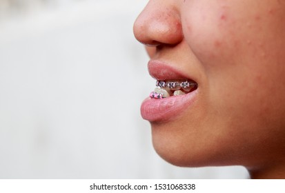 Teen Asian Ethnicity Problems With Teeth Can Be Treated With Braces To Treat Symptoms Prognathism Make Mouth Awry.