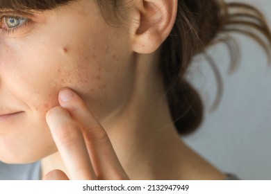 Teen girl with acne problem on beige background, closeup. Acne skin because of sebaceous gland production disorders. - Shutterstock ID 2132947949