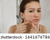 dermatology acne