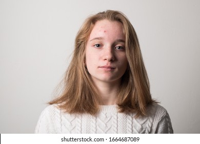 Teen girl in acne. Studio image of a pretty young girl with acne face.