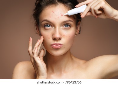 Teen girl with problem skin applying treatment cream on beige background. Skin care concept