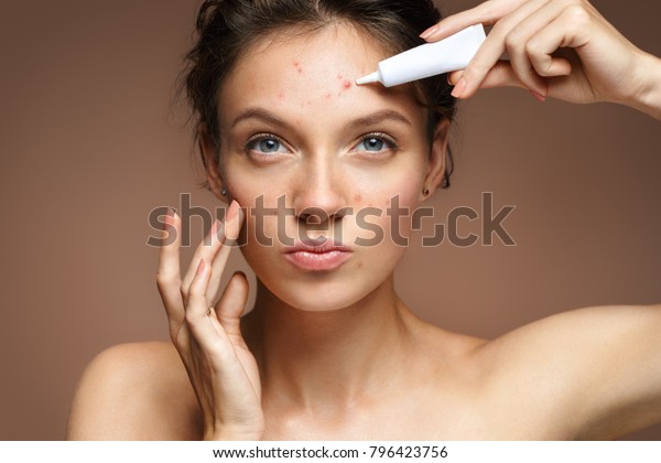 Teen girl with problem skin
applying treatment cream on beige background. Skin care
concept