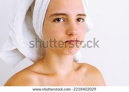Teen girl with teenage acne on face, with bath towel on hair, with sad expression. gloomy upset girl, brown eyes, emotion of discontent and despair on face. Teen skin care concept, problem skin