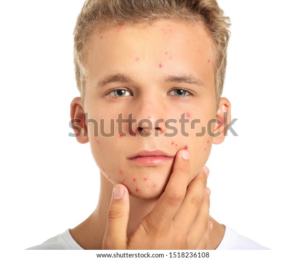 Teenage Boy Acne Problem On White Stock Photo 1518236108 | Shutterstock