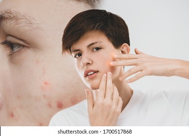 Teenage boy suffering from acnephobia examining face. Vision of person with problem skin