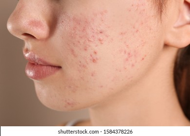Teenage girl with acne problem on beige background, closeup