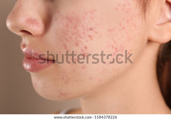 Teenage girl with acne problem on beige\
background, closeup