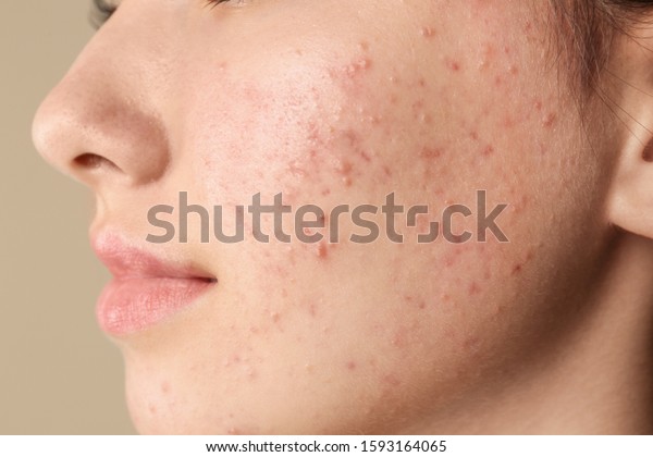 Teenage girl with acne problem on beige\
background, closeup