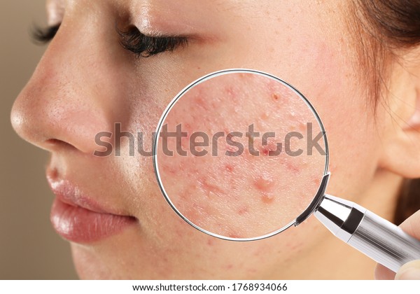 Teenage girl with acne problem visiting\
dermatologist, closeup. Skin under magnifying\
glass