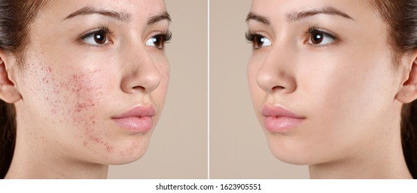 Teenage girl before and after acne treatment on beige background