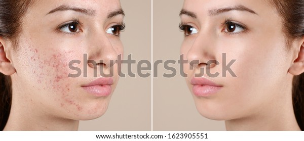 Teenage girl before and after acne treatment\
on beige background