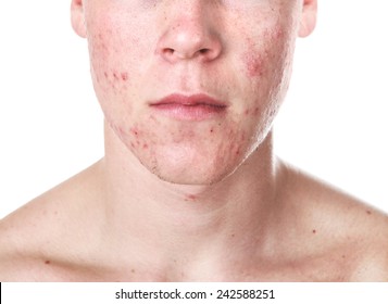 Teenager with Acne