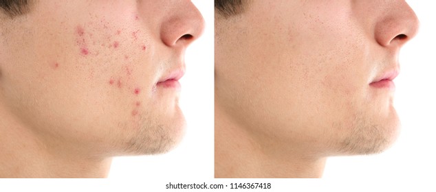 Teenager Before And After Acne Treatment On White Background, Closeup. Skin Care Concept