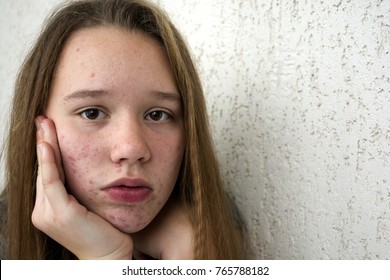 A teenager girl is going through because of acne on her face.A teenager girl experiences that on the face of a pimple.