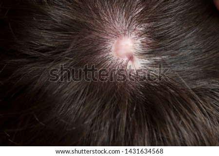 A teenager who was born with Nonsyndromic aplasia cutis congenita,  a congenital defect with an absence of the epidermis, dermis and sometimes subcutaneous tissues. Usually on the top of the head.