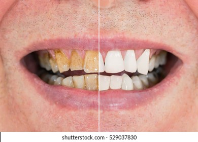 Teeth Before After