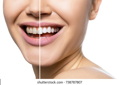 Teeth before and after care, therapy and whitening. Laughing woman mouth with great teeth over white background. Healthy beautiful female smile. 