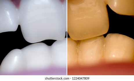 Teeth Before After, Close-up Of A Mouth With Crooked Teeth And Malocclusion.