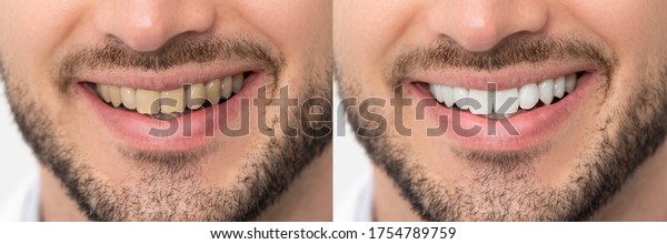 402 Before And After Bad Teeth Images, Stock Photos & Vectors