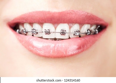 teeth with braces - Shutterstock ID 124314160