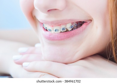 Teeth With Braces.