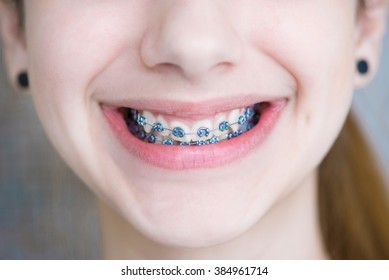 Teeth With Braces.