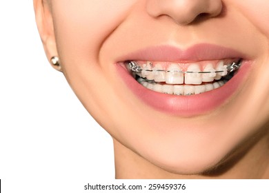 Teeth With Braces, Dental Care Concept, Front View. Smile With Sapphire Braces. The Gap Between The Teeth. Orthodontic Treatment.