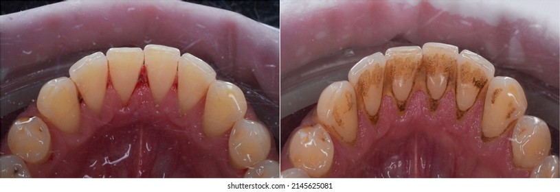 Teeth Calculus And Tartar Cleaning