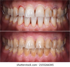 Teeth Calculus And Tartar Cleaning