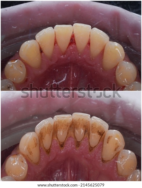teeth calculus and tartar\
cleaning