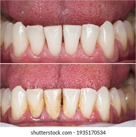 Teeth Cleaning Before And After Picture