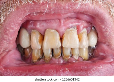 impotencia de la placa dental impotencia de la placa dental
