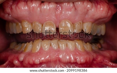 The teeth erosion and large exostosis in oral cavity ( torus )