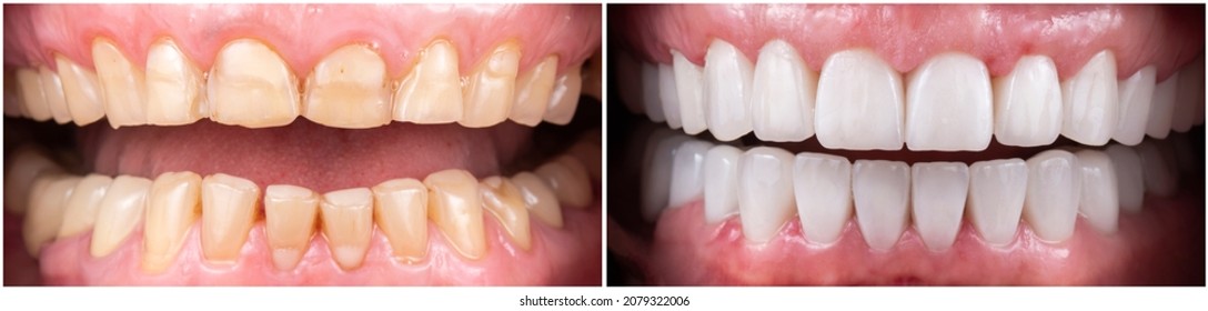 Teeth Indirect Restoration And Making New Smile By Ceramic Veneers B1 Color