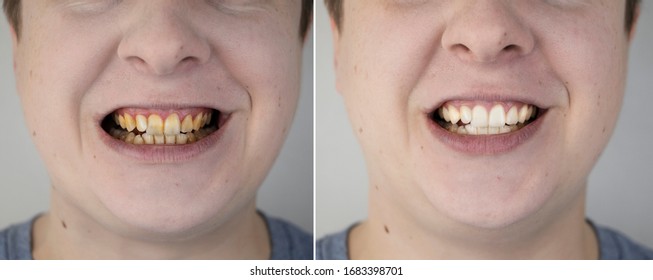 Teeth of a man before and after bleaching. The dentist removed yellow plaque from tooth enamel. The concept of professional toothbrushing in a dental clinic