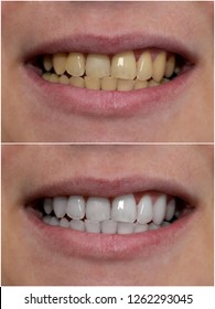 Teeth post whitening