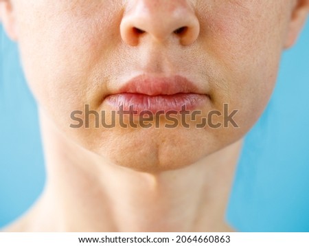 Teeth Problem. Gumboil, flux, bruise and swelling of cheek. Closeup Of Beautiful Woman with swollen cheeks. Attractive Female Feeling Painful Toothache, Dental Health And Care Concept macro