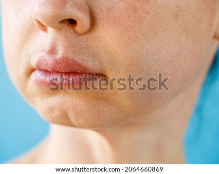 Teeth Problem. Gumboil, flux, bruise and swelling of cheek. Closeup Of Beautiful Woman with swollen cheeks. Attractive Female Feeling Painful Toothache, Dental Health And Care Concept macro