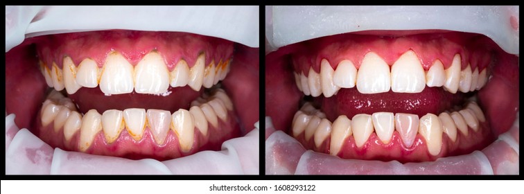 Teeth Proffesional Deep Cleaning Before And After Picture