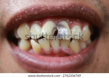 Teeth show a broken front tooth. Damage is visible, with dark decay and chipped enamel. Mouth is slightly open, showing gums and lips. Image captures dental health issues in a realistic way