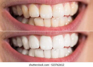 Teeth Whitening Before After - Shutterstock ID 523762612