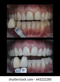 teeth whitening ,before and after