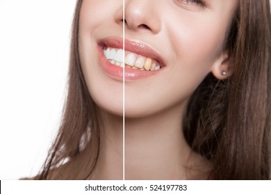Teeth Whitening Before and After the Procedure. Perfect Smile after visiting the Dentist.  Beautiful Teeth Before and After Procedures. Perfect Whitening without harm to the Enamel of the Teeth       