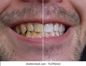 Teeth Whitening Concept. Smiling Man With Yellow Teeth - Before And After.