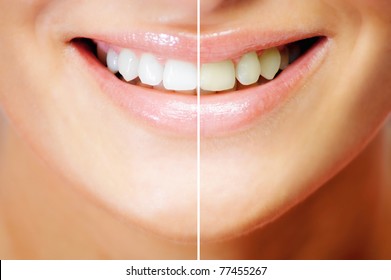 Teeth Whitening , Cosmetic Dentistry , Before / After Comparison