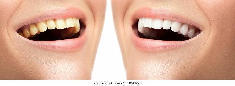Teeth whitening and hygiene. Result after treatment in the professional dental clinic.