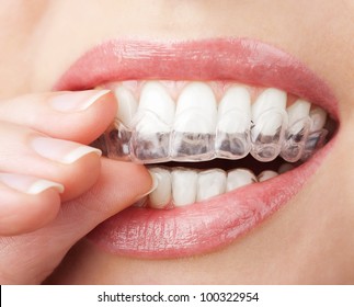 Teeth With Whitening Tray