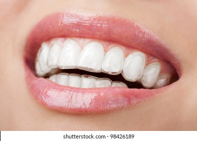 Zähne mit weißem Träger
